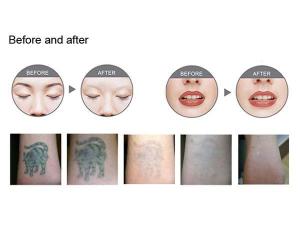  Laser dermatologique / enlèvement tatouage / FG009 