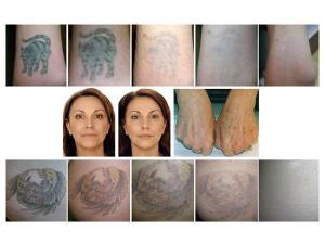  Laser dermatologique / enlèvement tatouage / FG2010 